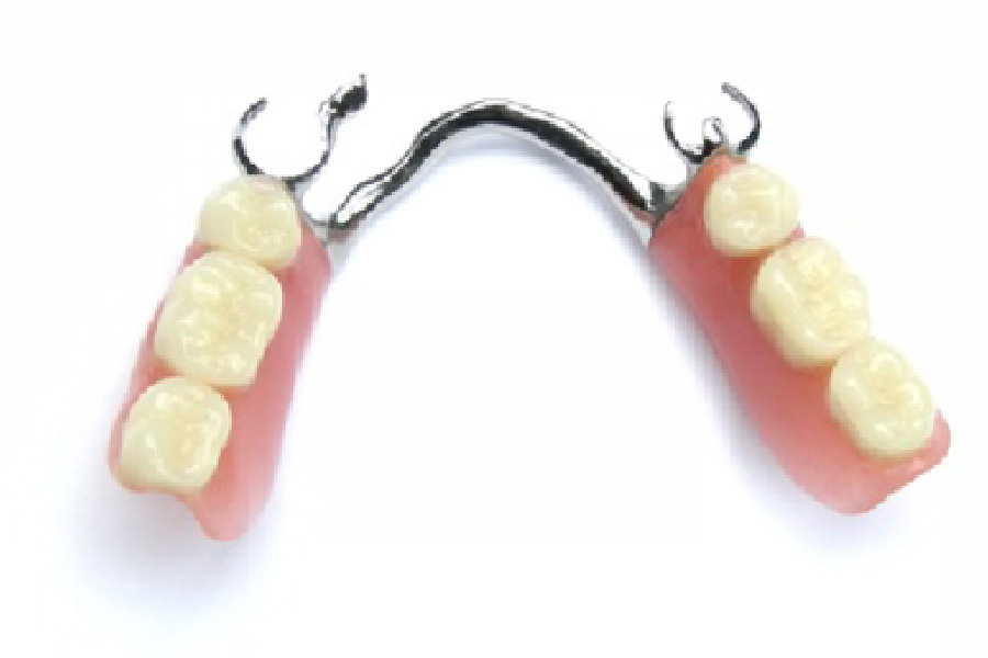 歯だけで支える部分床義歯(コーヌスクローネ)